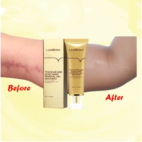 LANBENA Acne and Scar Removal Ointment