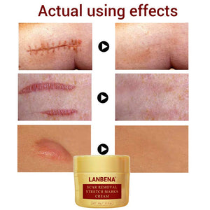 LANBENA Scar and Stretch Marks Removal Cream